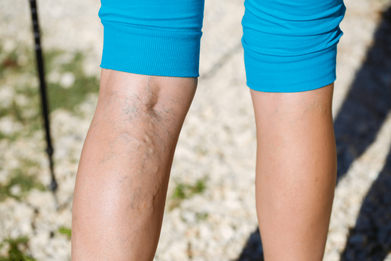 What Happens if Varicose Veins Are Left Untreated?