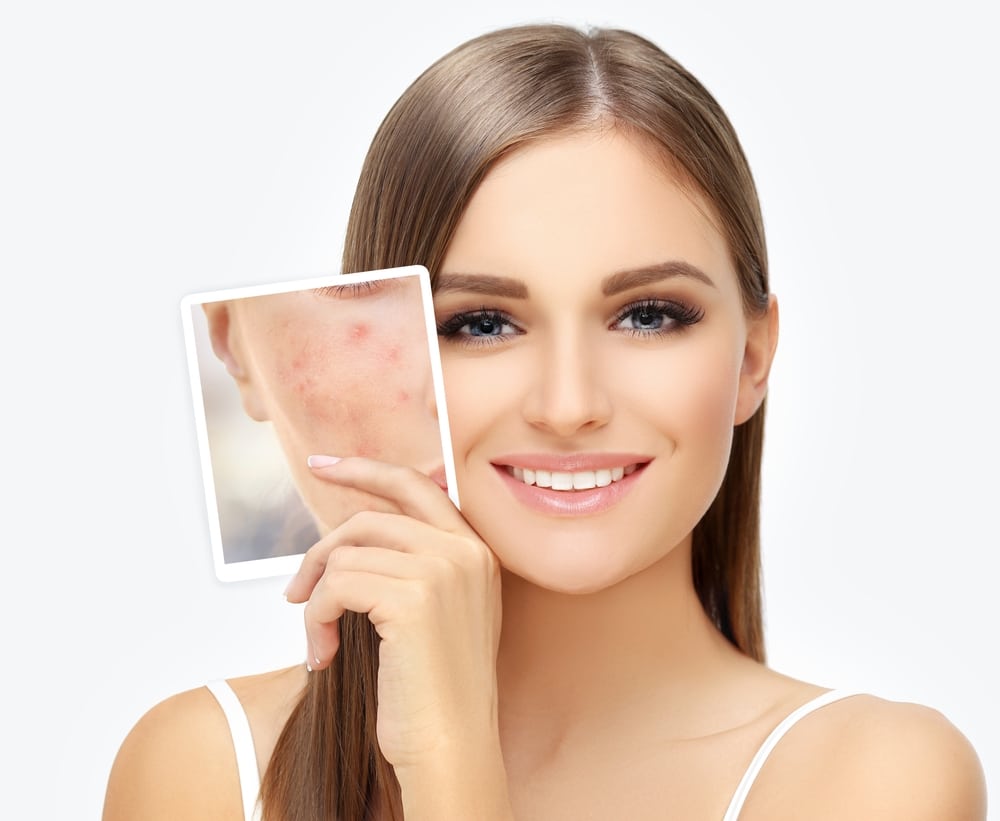 Acne Scars | Reno Sparks MedSpa